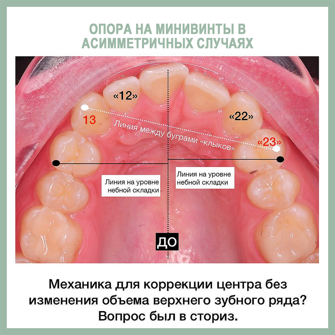 Опора на минивинты (МВ) в асимметричных случаях. - интересно об ортодонтии,  имплантации и протезировании зубов